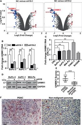 UHMK1 Is a Novel Marker for Personalized Prediction of Pancreatic Cancer Prognosis